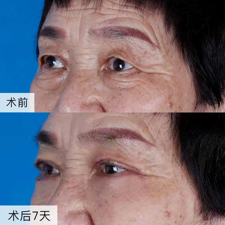 Loại bỏ nếp nhăn mắt