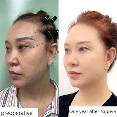 Phẫu thuật thay đổi