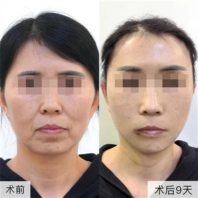 Loại bỏ nếp nhăn